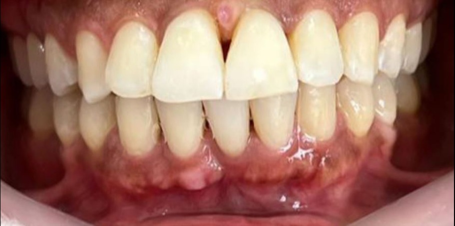 Close-up of lower and upper front teeth with red, swollen, and inflamed gums indicating possible gum disease.